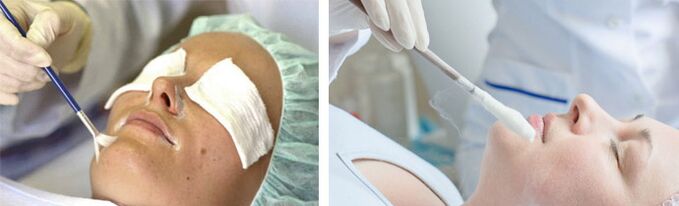пилинг и криотерапија за подмладување на кожата