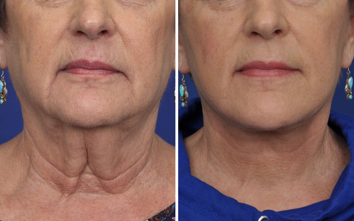 пред и после процедури за подмладување на кожата