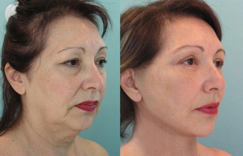 Резултат на подмладување на затегнување на кожата на лицето со конци