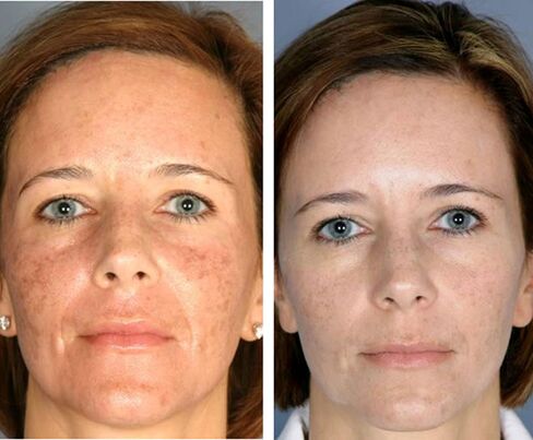 Пред и по фракционална термолиза на лицето