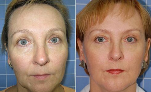 Пред и по фракционо ласерско подмладување на лицето