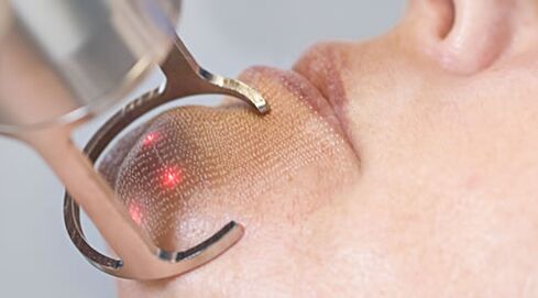 Текот на постапката за фракционо ласерско подмладување на кожата на лицето