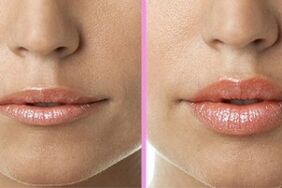 пред и по постапката за обновување на усните